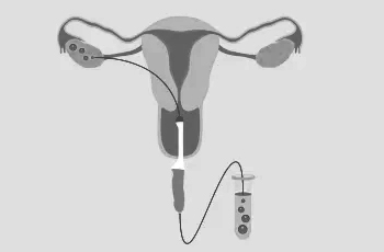 La Ponction ovocytaire