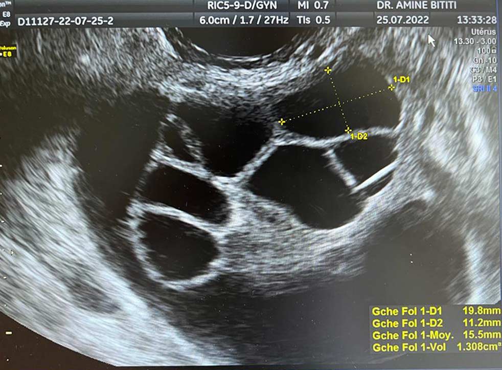 La stimulation ovarienne